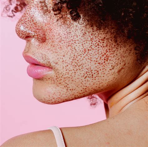 TCA Peels: What To Know and How They Work .